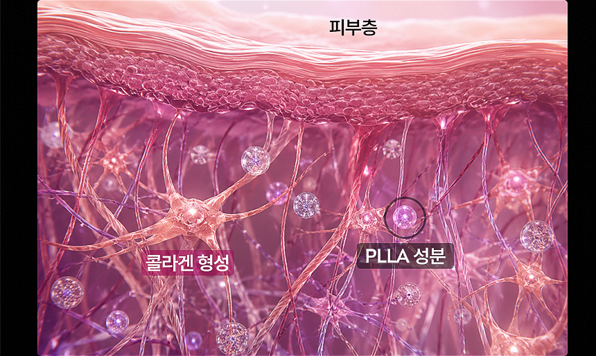 스컬트라 피부 탄력과 볼륨 개선