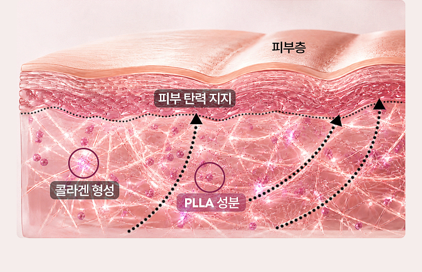 스컬트라 콜라겐 형성과 자연스러운 볼륨 변화